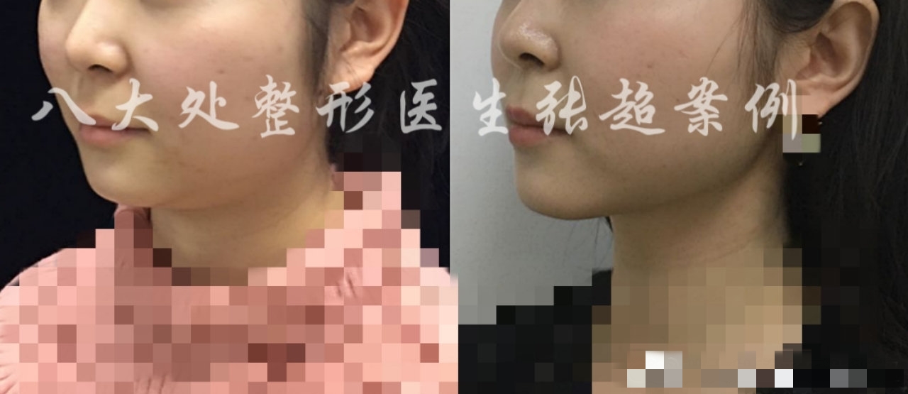 八大处整形张超,八大处张超最新视频