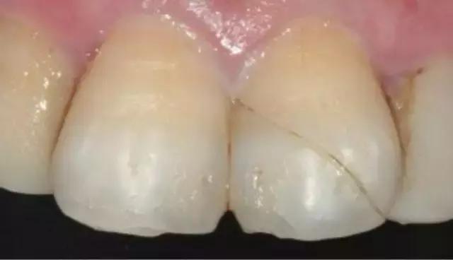 前牙磕掉了一块怎么办？#葉子口腔科普#