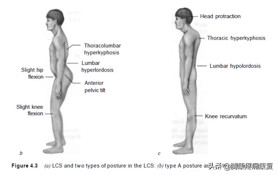 怎么解决下交叉综合症,下交叉综合征改善训练
