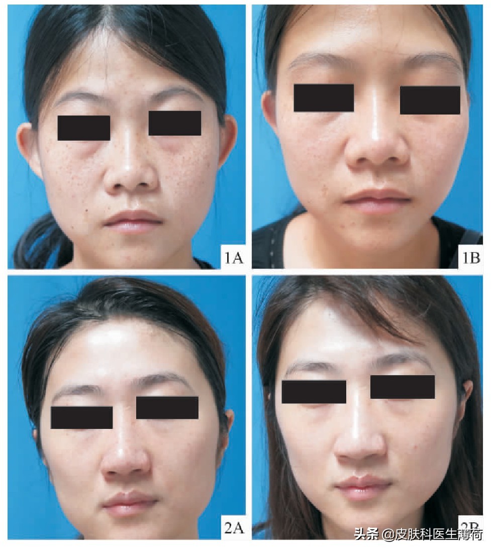 激光点阵祛痘坑收缩毛孔仪器,皮秒激光祛雀斑效果图