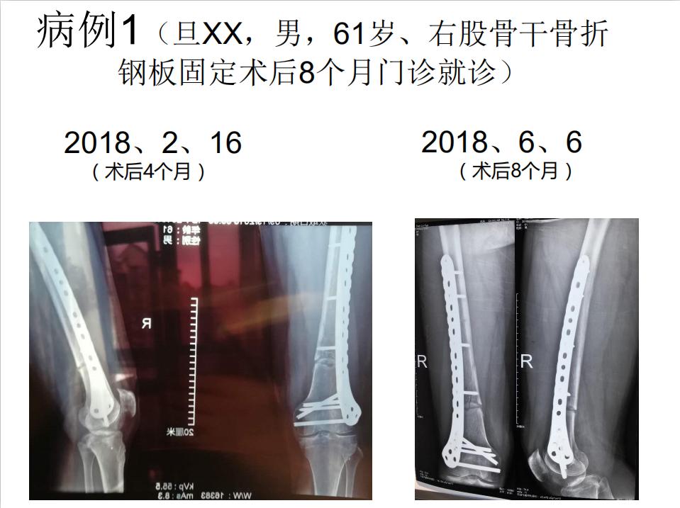 平乐骨科推拿教学,中医治疗骨折畸形愈合