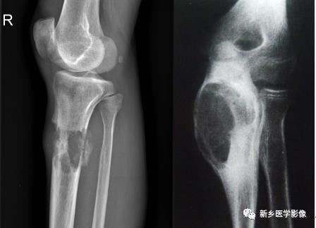 骨骼坏死最佳治疗方法,骨骼疾病治疗