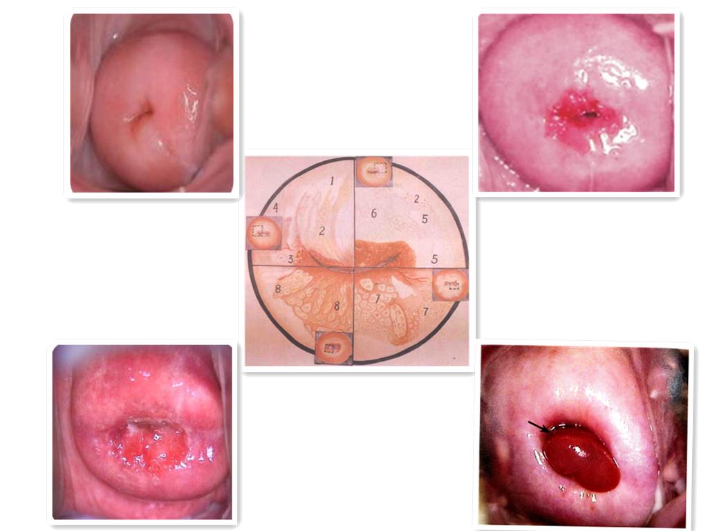 宫颈糜烂离宫颈癌还有多远呢？