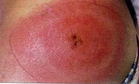 关于蚊虫叮咬引起的皮肤病,最近皮肤容易被蚊虫叮咬