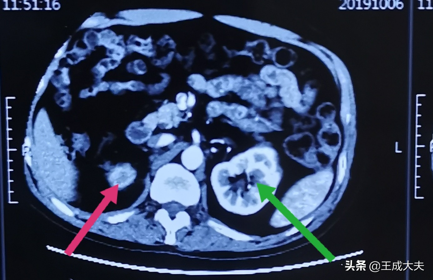 关于尿路结石的病因说法不正确,结石方面辟谣