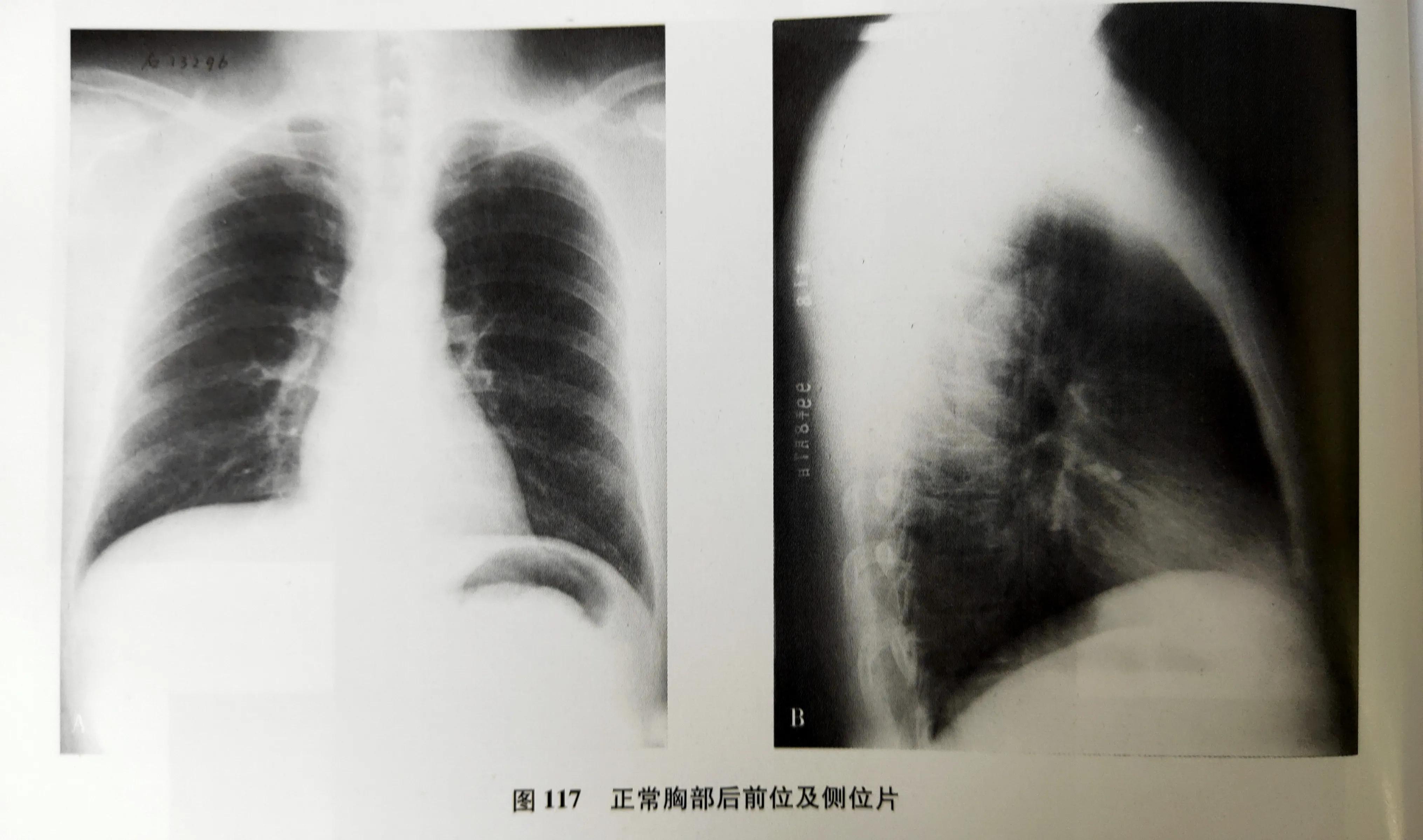 学习《X线读片指南》第一节X线成像的基本原理