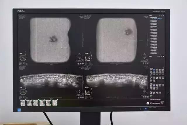 平胸妹子做不了钼靶？太平公主不用愁ABUS为你解忧