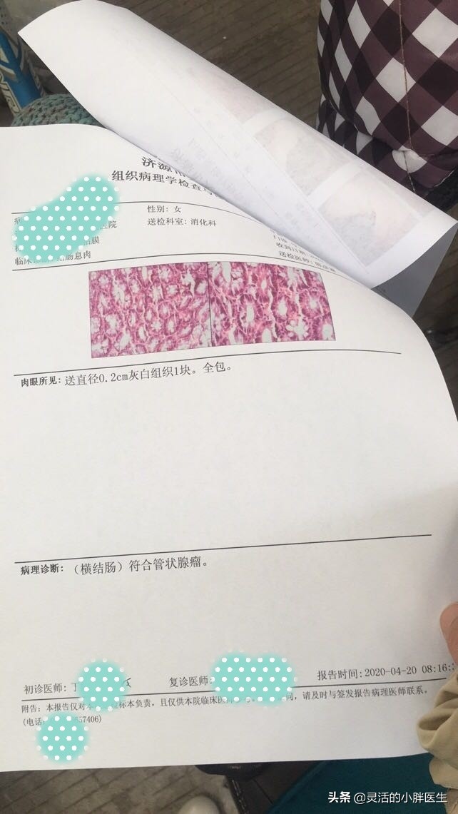 结肠息肉会转癌症吗,结肠息肉属良性肿瘤能变癌吗