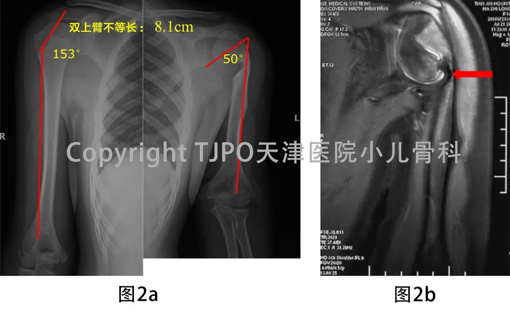 小儿骨科矫正足内翻,宝宝足内翻矫形支具