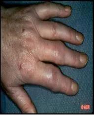 科普关节炎诊疗指南,类风湿医生健康科普预防知识