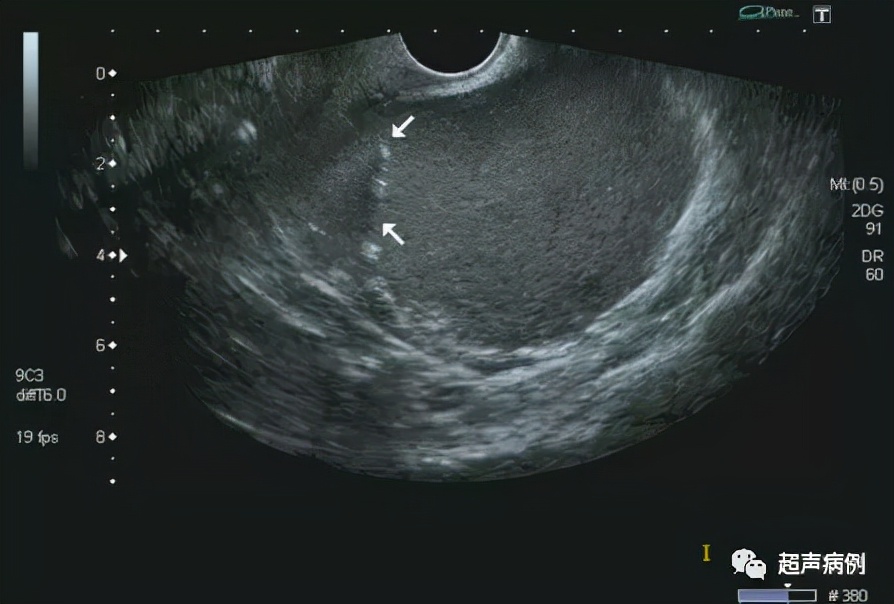 臀部包块超声检查,盆腔囊性包块10公分肚子剧痛