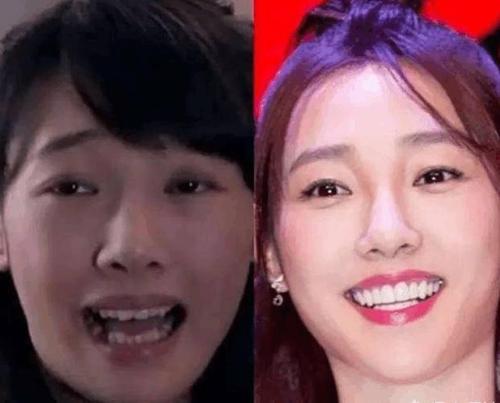 哪些明星整牙后像整容,明星整牙变美了