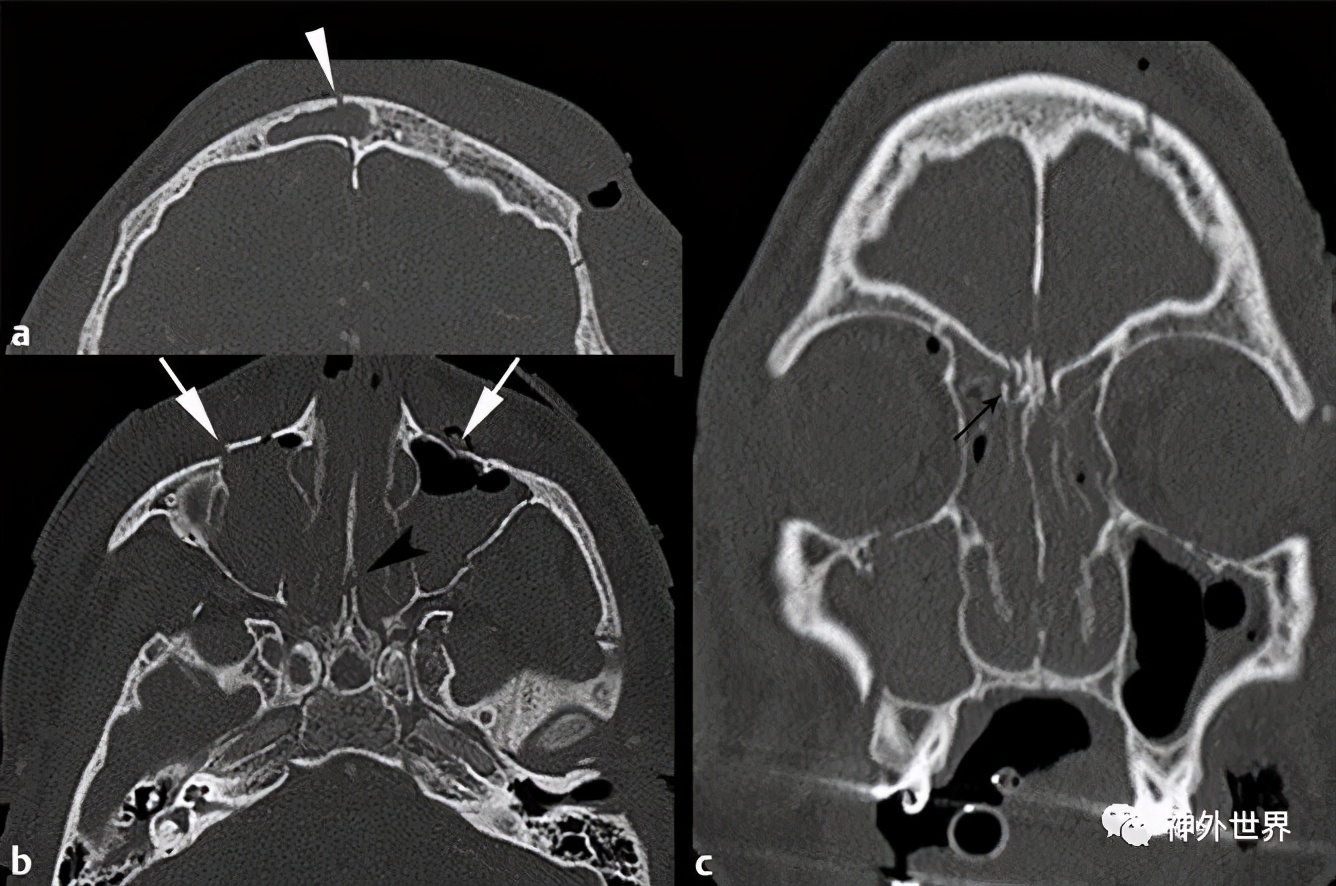 颅底骨折合并脑脊液漏伤情鉴定,颅底骨折伴脑脊液漏右眼眶骨折