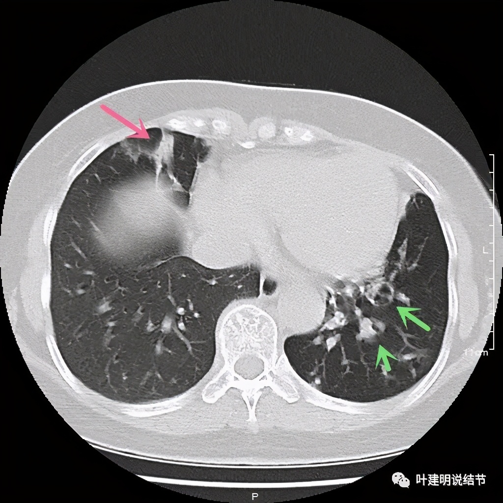 这样的实性结节伴小空洞会是肺癌吗?