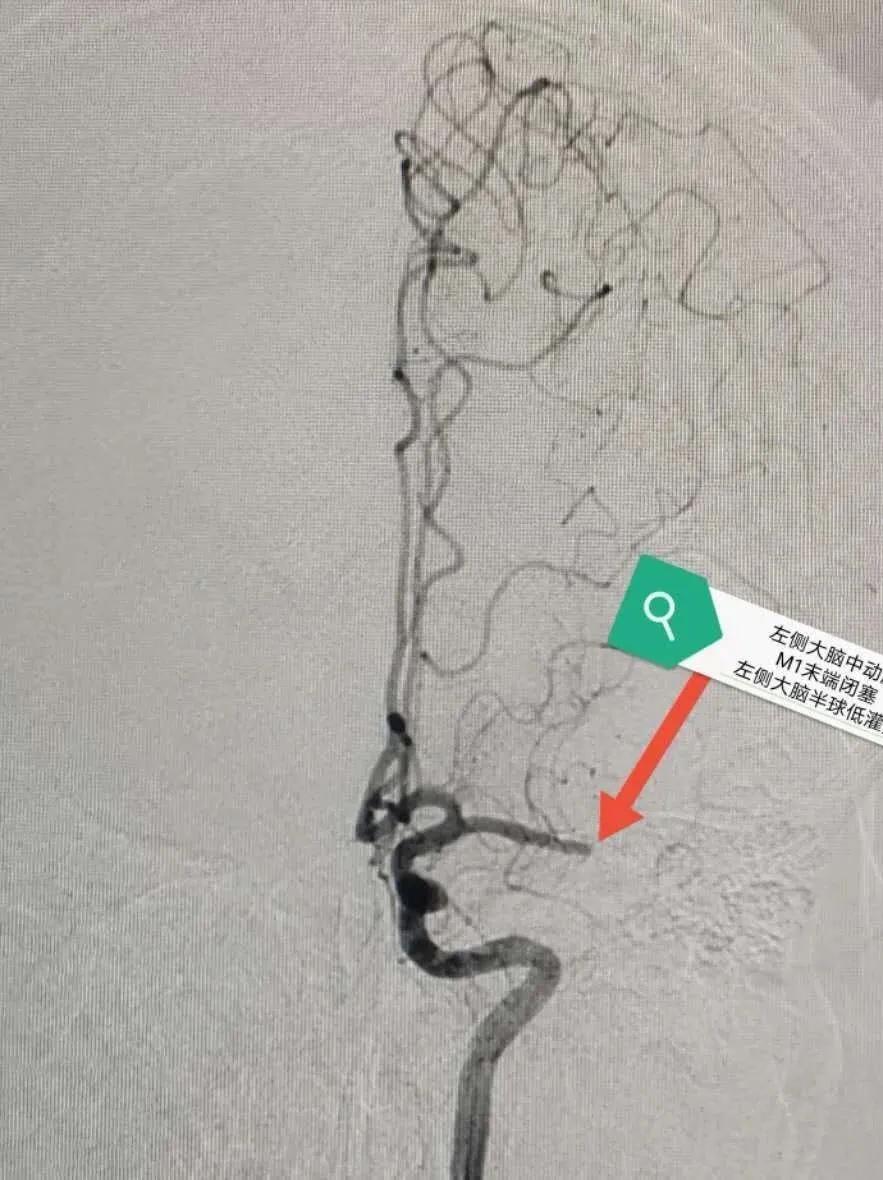 突发右侧偏瘫失语一个月,偏瘫突然失语