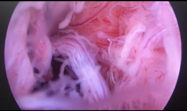 类风湿造成的关节变形可恢复吗?大多不行,有两种情况可以