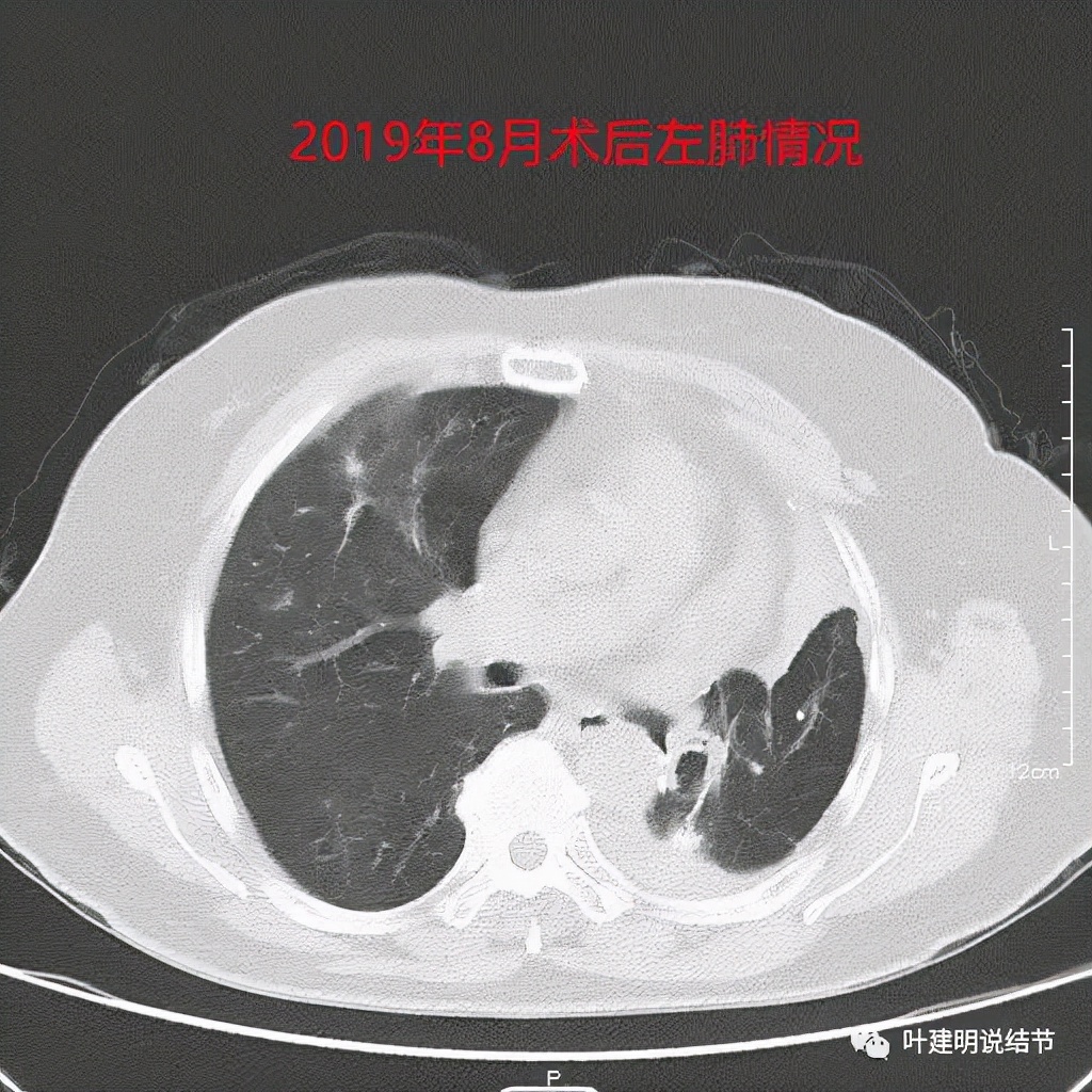 左肺癌手术半年右肺下角还有炎症,左下肺癌晚期