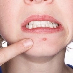 脸部不同地方长痘原因及解决方法,脸上各部位长痘的原因和解决方案