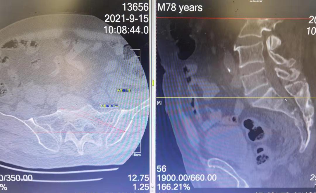 摘取皇冠,聊城市人民医院骨外科