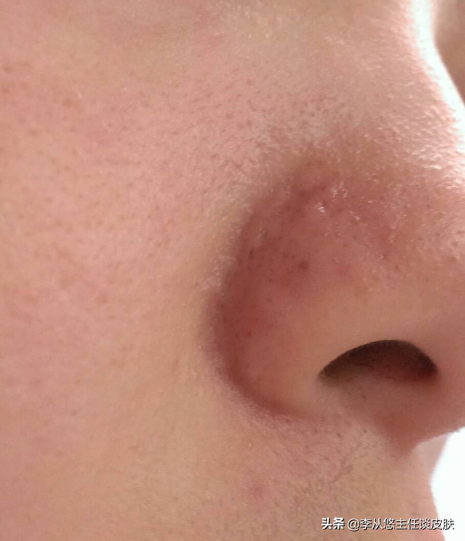 鼻子上长痘痘是最尴尬的了,红肿会显得人很像小丑