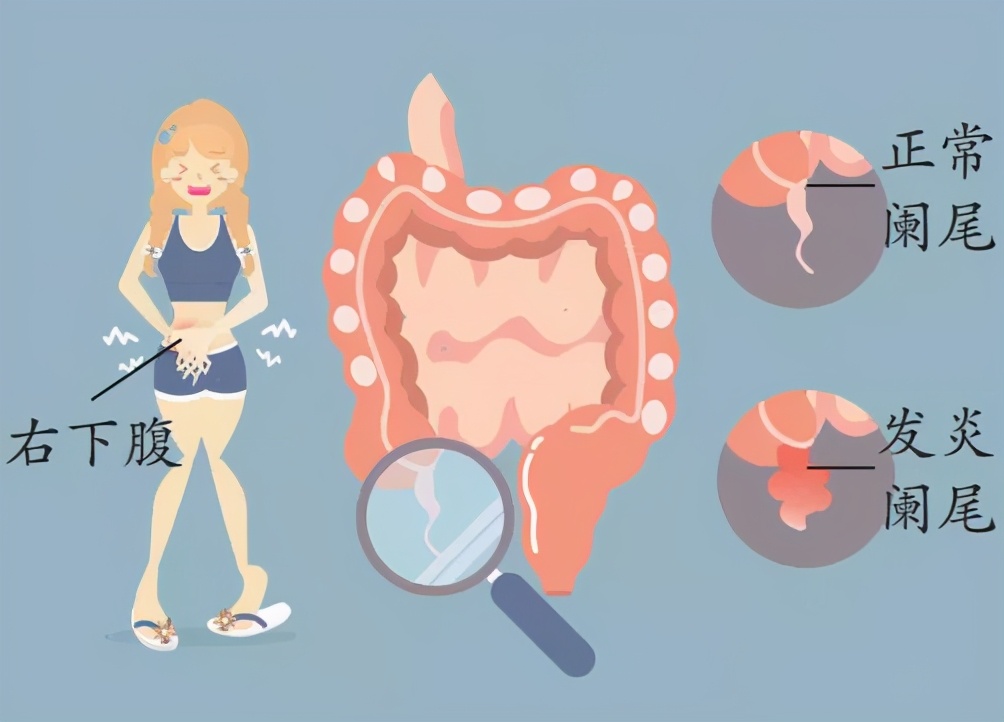 阑尾炎一定要开刀吗？听说不开刀能保住阑尾，靠谱吗？