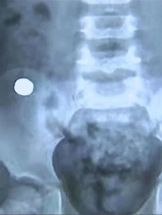 4岁男孩吃了它，体内充血水肿糜烂！快把家中这个东*藏西**好