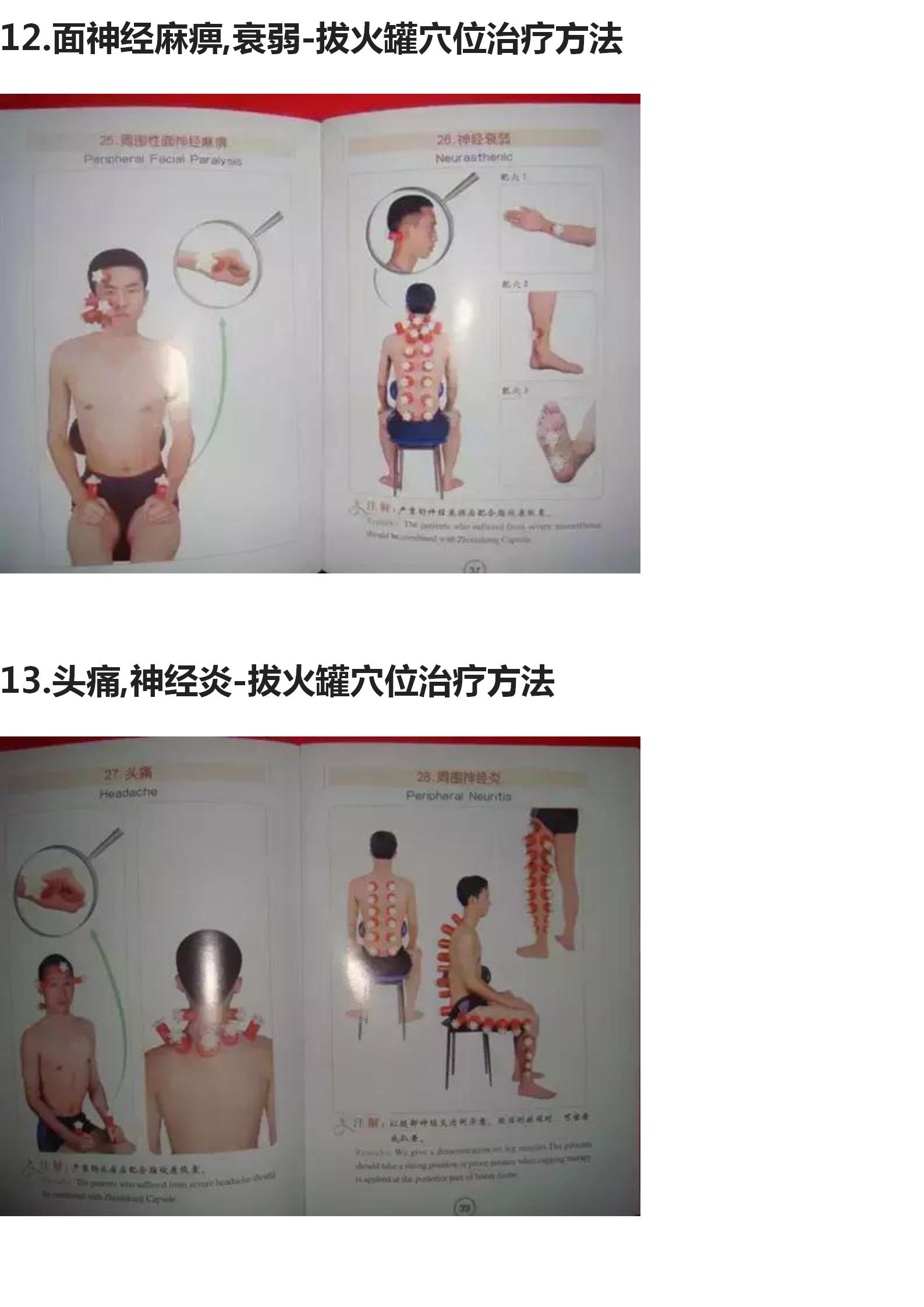 拔罐的手法和穴位图,中医拔罐穴位图片及作用