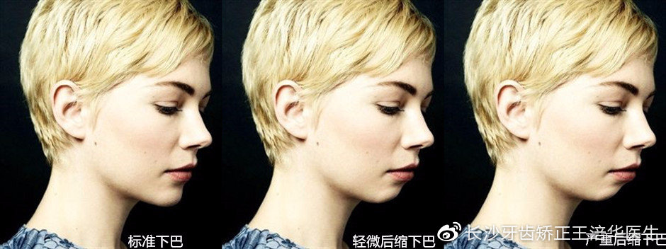 下巴短小怎么办不整容可以改变吗,下巴短后缩下颌线不明显怎么改善