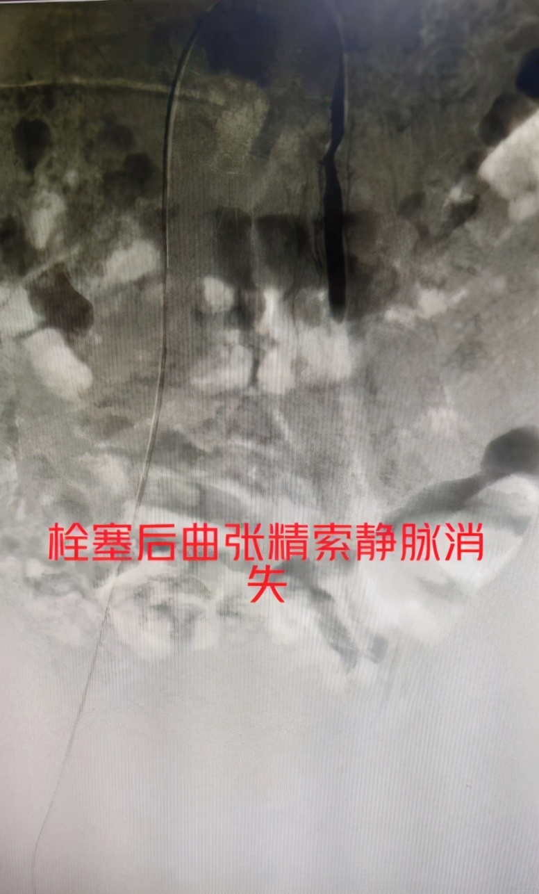 小伙子兵检不合格,当兵血管瘤不合格可以复检吗