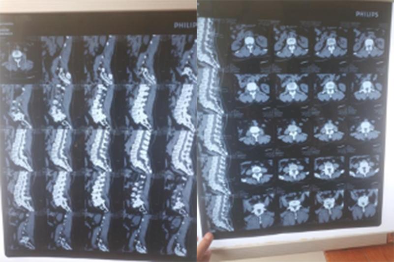 医生说腰痛是什么原因,医生治疗腰疼病人视频