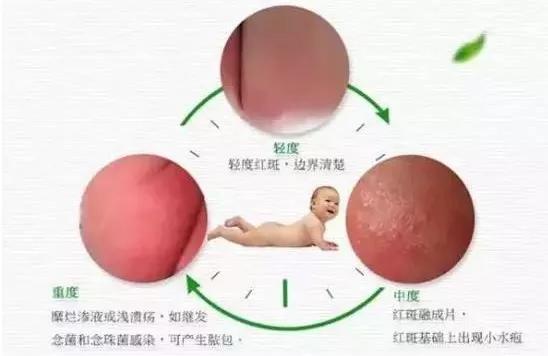 怪不得宝宝总是红屁屁,原来是这里出了问题!