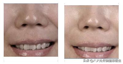 眼窝填充自体脂肪和玻尿酸哪个好,鼻唇沟凹陷物理改善方法