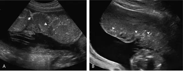 临床上最常见的异常胎盘,前置胎盘和低置胎盘超声