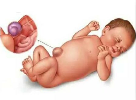 婴儿肚脐化脓新闻,出生小孩肚脐感染怎么办