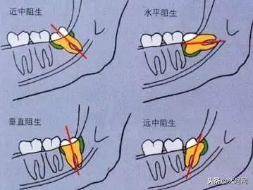 最里面智齿到底要不要拔掉,没长出来的智齿到底要不要拔