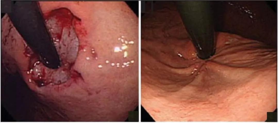 胃食管反流引起咳嗽吃药能缓解吗,胃食管反流咽喉异物感怎么吃药