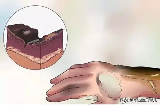 宝宝被烫伤第十三天,宝宝被开水烫伤要打针吗