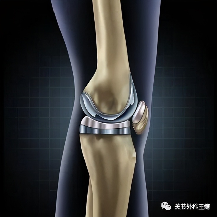 人工膝关节使用60年寿命,人造膝关节有使用年限吗