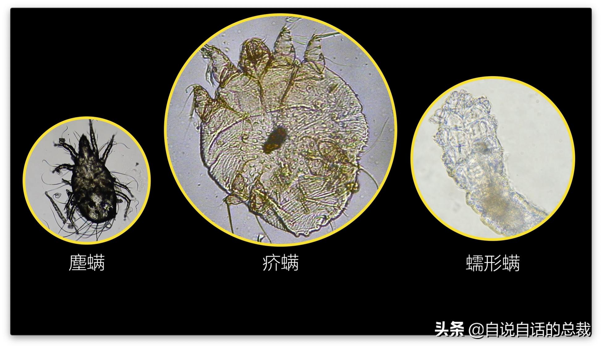 毛囊异型,毛囊里的异形物