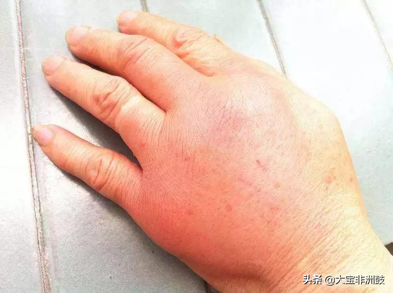 打非洲鼓手疼的几点分析玩非洲鼓手疼之原因