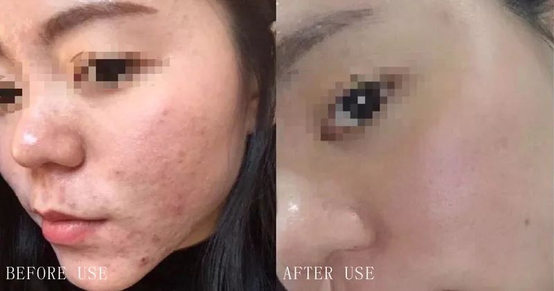 透明质酸面膜有几款,安利一款美白淡斑面膜