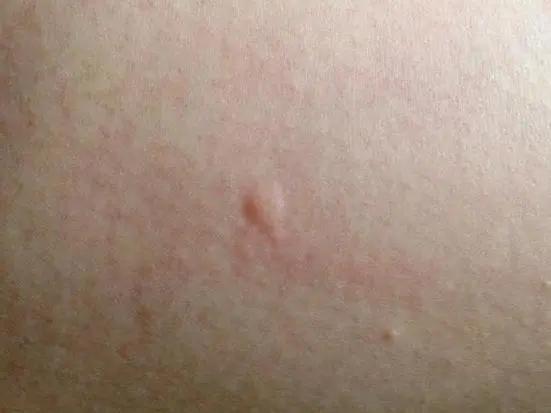 总被蚊子咬有什么驱蚊妙招,为什么老是被蚊子咬怎么解决