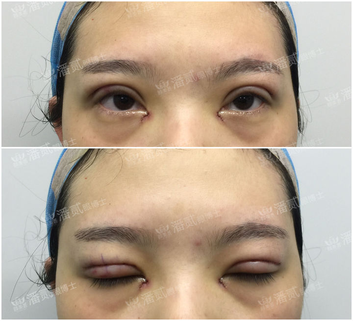 原来双眼皮不好看有必要继续割吗,割双眼皮是不是越修复越难看