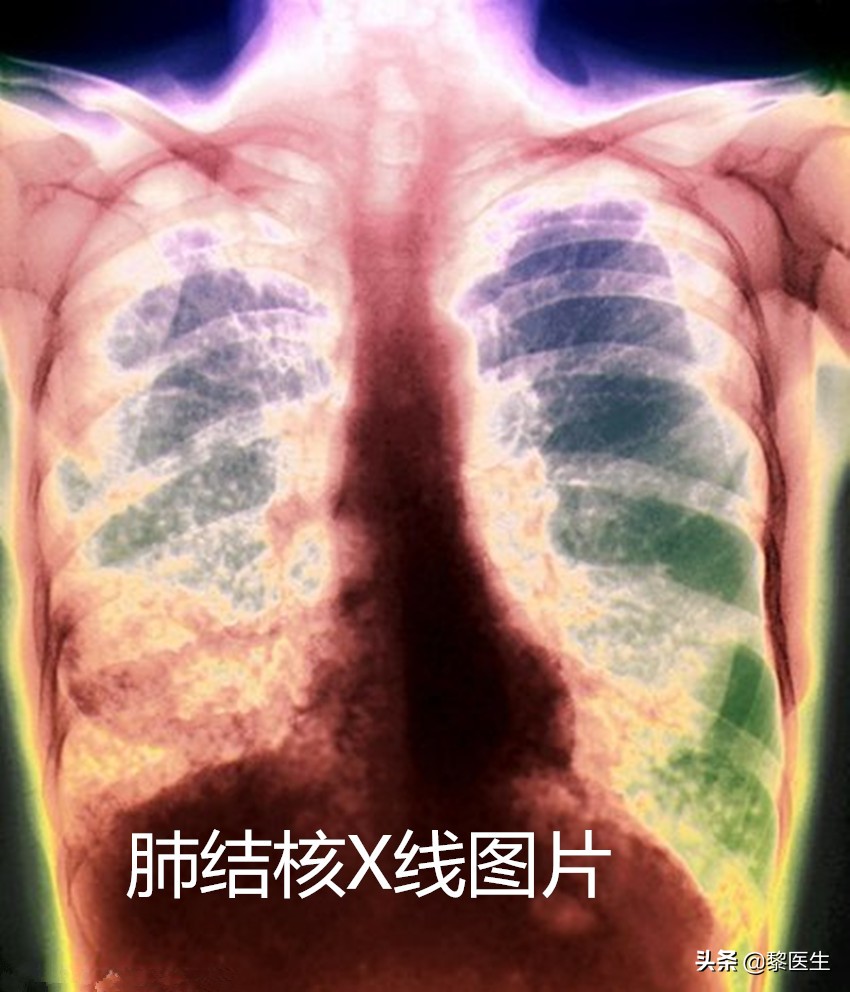 肺结核药物副作用胃疼怎么办,肺结核药物对心脏有副作用吗