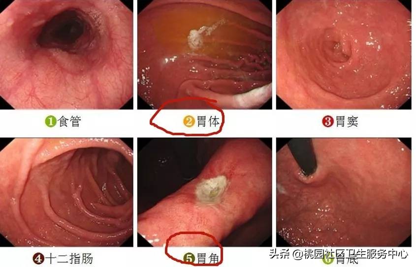 手把手教你：3分钟看懂胃镜报告