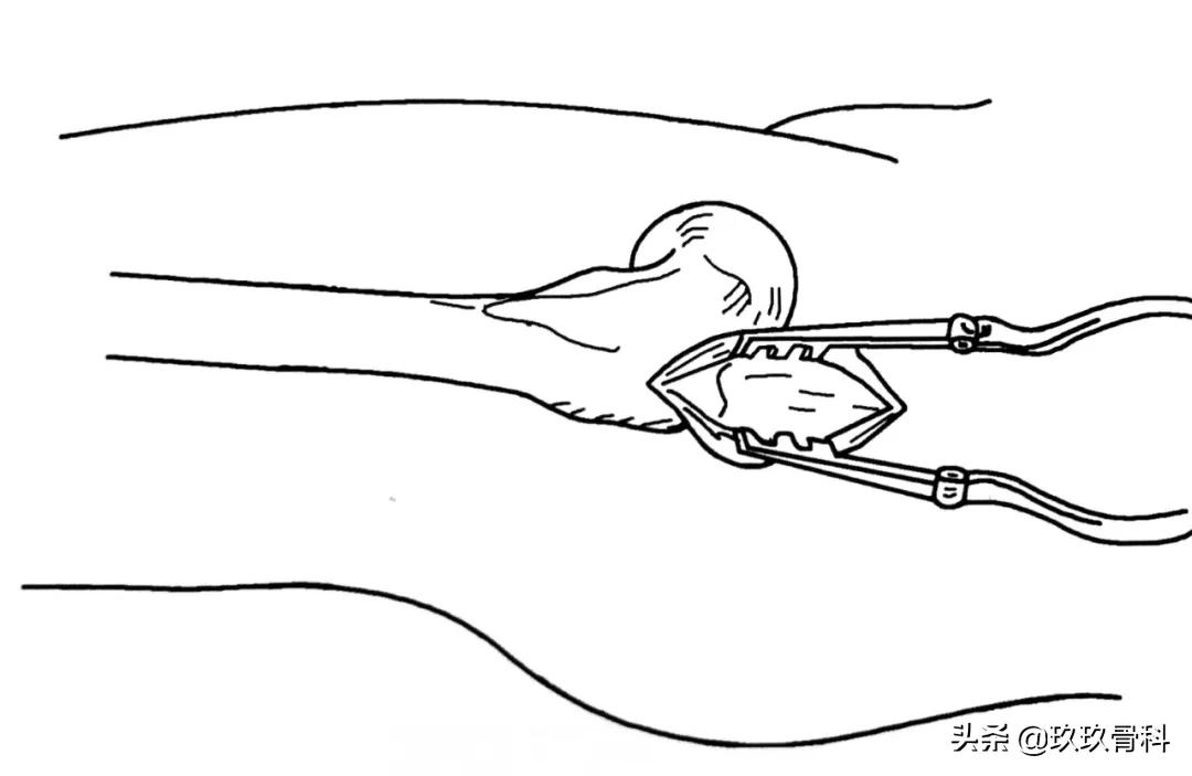 骨科用髓内钉什么材料,骨科髓内钉的作用