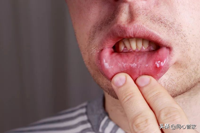 冠心病吃药后胃痛,吃冠心病的药会口腔溃疡吗