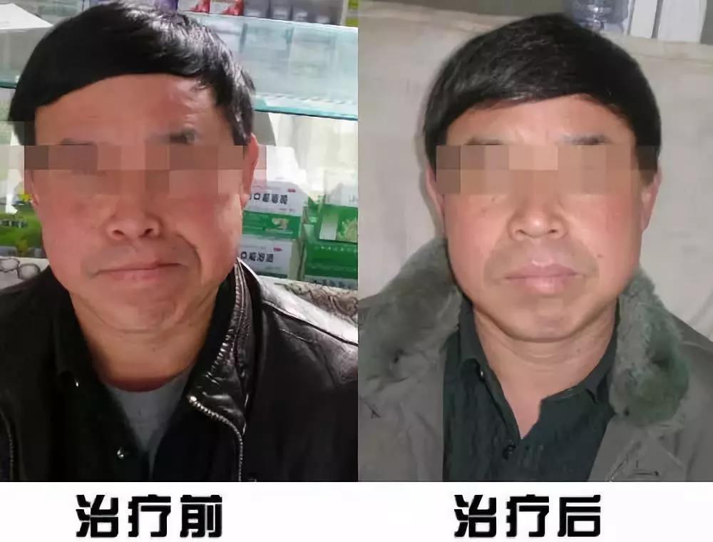 面瘫康复训练方法,八个小步骤