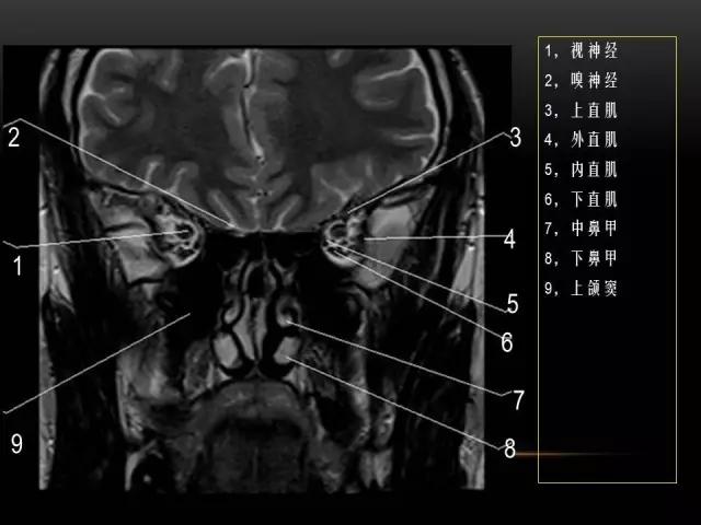 鼻腔鼻窦及颅底ct影像解剖,鼻窦解剖mri