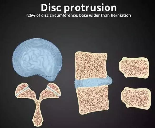 腰椎间盘的膨出和突出有什么区别,腰椎间盘膨出和突出有什么区别